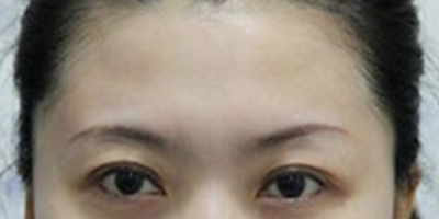 自體脂肪豐太陽穴術(shù)后