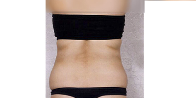 按摩減肥術(shù)前