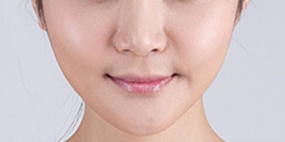 曼特波隆下巴術(shù)后