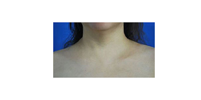 聚能震波吸脂術后