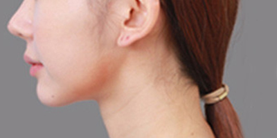 硅膠墊下巴術后