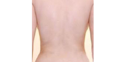 射頻溶脂瘦背部術(shù)后