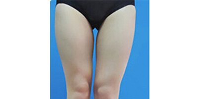 大腿吸脂術前