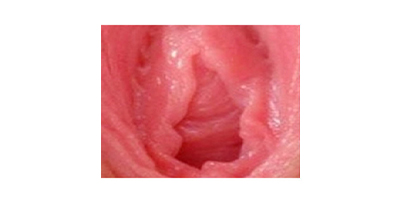 處女膜修復(fù)術(shù)前