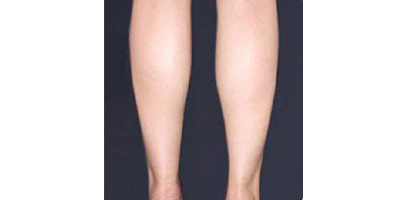 冷凍溶脂瘦小腿術(shù)后