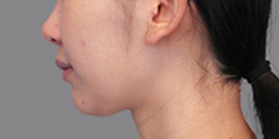 硅膠墊下巴術前