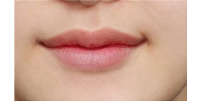 玻尿酸豐唇珠術后