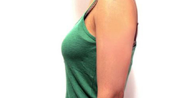 水動力吸脂術(shù)前