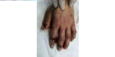 手指斷指再造術(shù)后