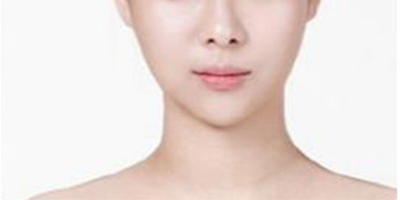 V-LINE瓜子臉手術術后