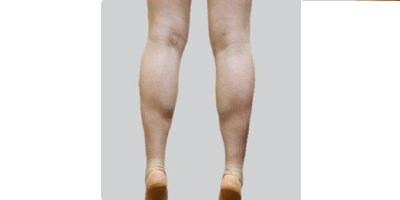 小腿神經(jīng)阻斷術(shù)術(shù)前