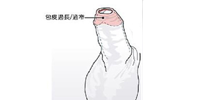 切包皮術(shù)前