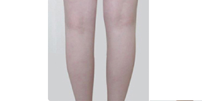 超聲溶脂瘦小腿術后