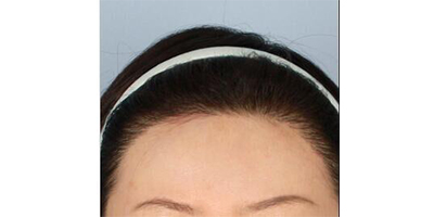 脫發(fā)際線術后