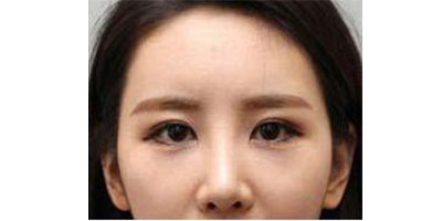 膠原蛋白豐淚溝術(shù)后