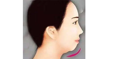 假體豐下巴術(shù)前