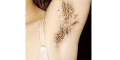 脫腋毛術(shù)前