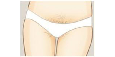 比基尼線脫毛術前