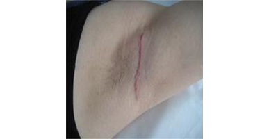 手術除腋臭術后