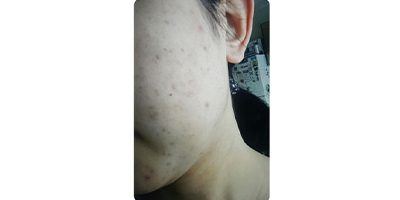 水楊酸煥膚術(shù)前