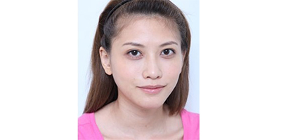 玻尿酸墊下巴術(shù)后