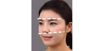 玻尿酸豐眉弓術(shù)后