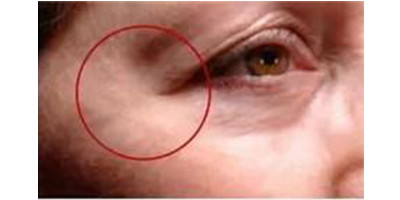 膠原蛋白注射術(shù)后