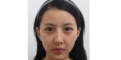 玻尿酸豐面頰術(shù)前