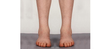 長短腿矯正術后