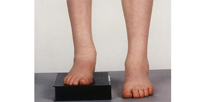 長短腿矯正術前