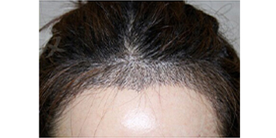 美人尖種植術(shù)后