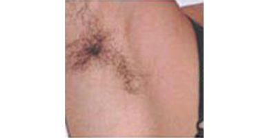 激光除腋臭術(shù)前