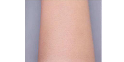 脫手臂毛術(shù)后