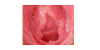 處女膜修復術前