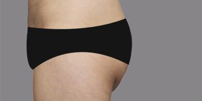 自體脂肪豐臀術(shù)前