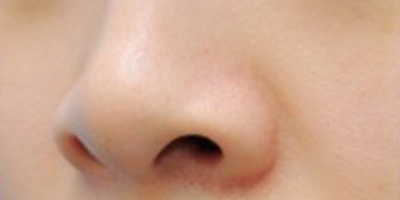 注射縮鼻頭術前