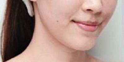 自體脂肪豐蘋果肌術(shù)前