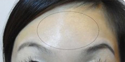 注射去動態(tài)紋術(shù)后