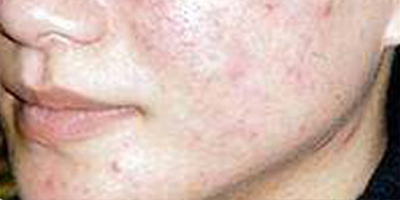 微針美塑術(shù)前