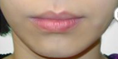 下巴膨體假體取出術(shù)前