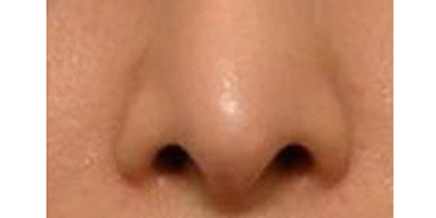 鼻部膨體假體取出術后