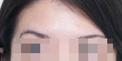 注射去面部細(xì)紋術(shù)后