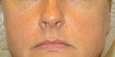 深藍(lán)射頻術(shù)前