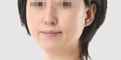 超聲提升術(shù)后