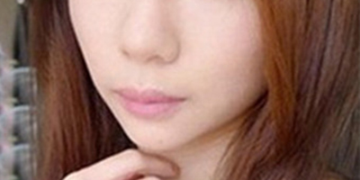 黃金煥膚術(shù)后