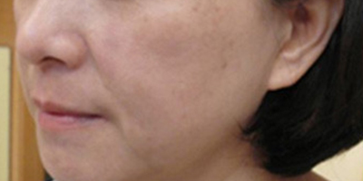 注射去木偶紋術(shù)前