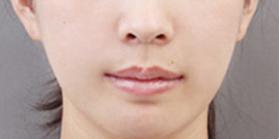 脂肪填充失敗修復(fù)術(shù)后