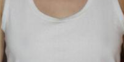 胸部假體取出術(shù)后