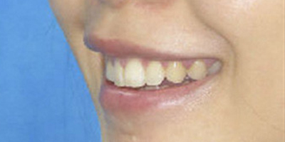 手術(shù)去露齦笑術(shù)后