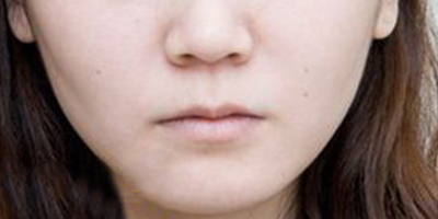 嘴角上揚術(shù)術(shù)前